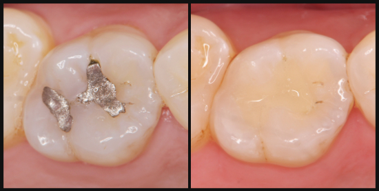 銀歯を白いセラミックの歯に変えた様子